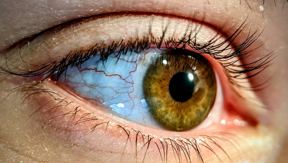 Conjunctivitis: What You Should Know