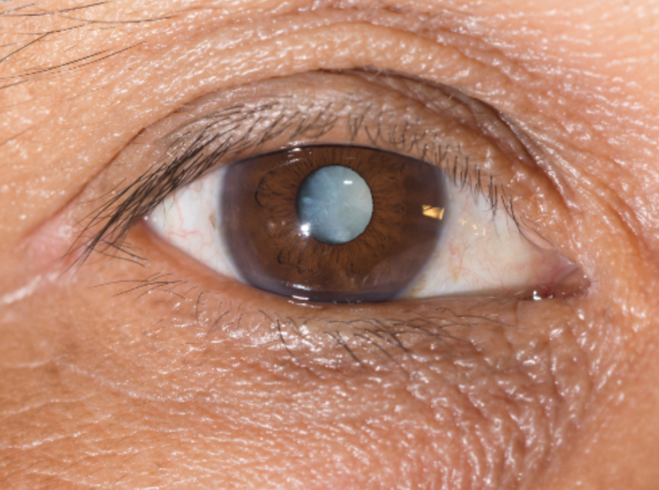 Cataract Surgery: What To Expect And What To Do