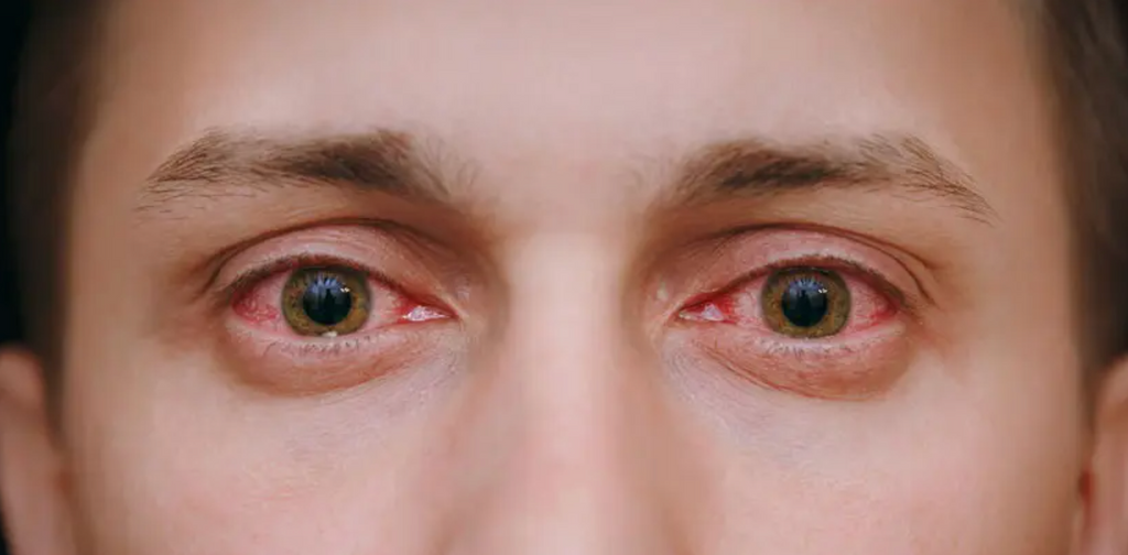 Unveiling the Mystery of Red Eyes: Causes, Symptoms, and Solutions