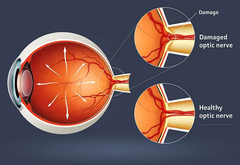 What Happens To Our Eyes When Eye Pressure Gets Too High?
